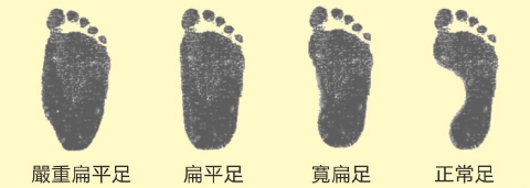 原来严重扁平足影响这么大！后悔矫正鞋科普太晚