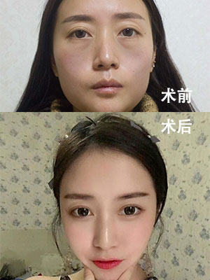 吸脂填充艾米丽潘红伟专家