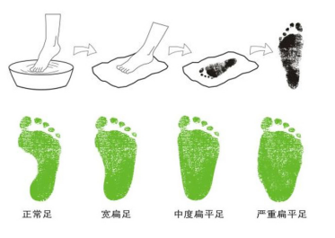 亲身经历，孩子同是严重扁平足的家长看过来！