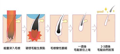 永久脱毛什么原理