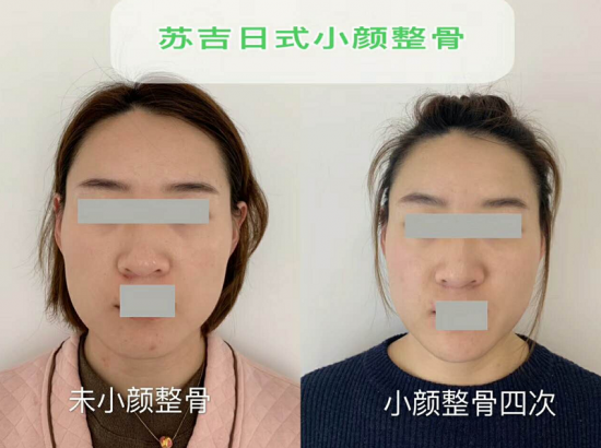 郑州整形排名_郑州元素酒窝整形图片(3)