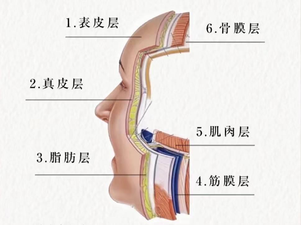 面部结构总体可以分为5层:表皮层,真皮层,皮下组织层,smas筋膜层,肌肉