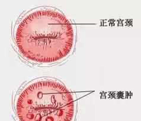 慢性的宫颈炎宫颈囊肿是日常生活中经常会有的情形,给患者的工作生活