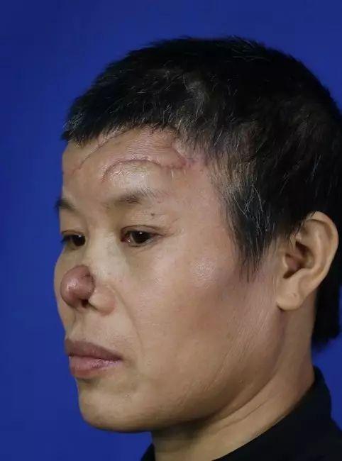 到初次鼻子功能修复后的畸形从事发时鼻子被咬掉的鲜血淋漓黄春娥老师